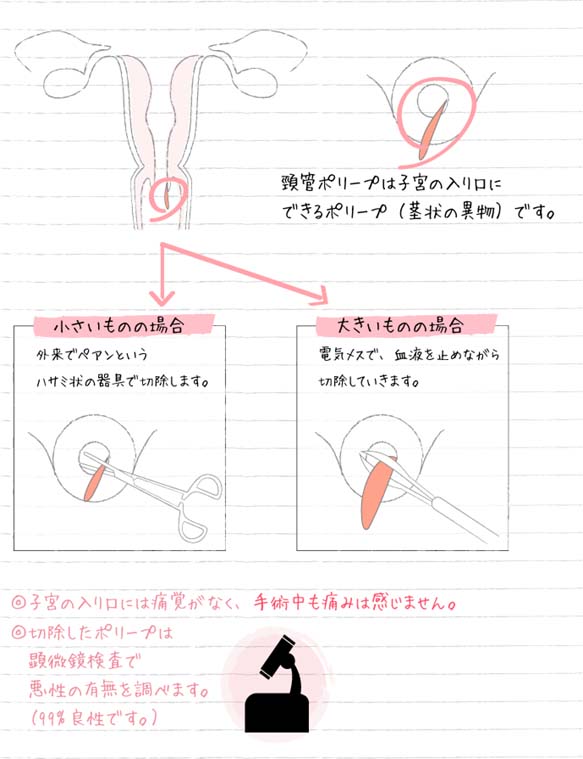 子宮頸管ポリープ切除手術