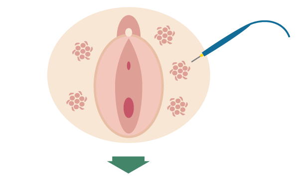 電気メスで強力に尖圭コンジローマを焼き切ります